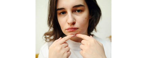 Understand hormonal acne triggers and learn natural solutions for clear, healthy skin. Explore clean skincare, lifestyle changes, and herbal remedies to manage breakouts caused by hormonal fluctuations