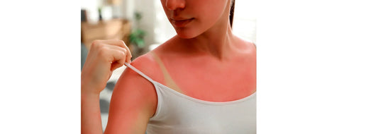 Young woman with a sunburn wearing a tank top. This photo is for YASOU's blog post called "The Impact of Weather On Skin.: