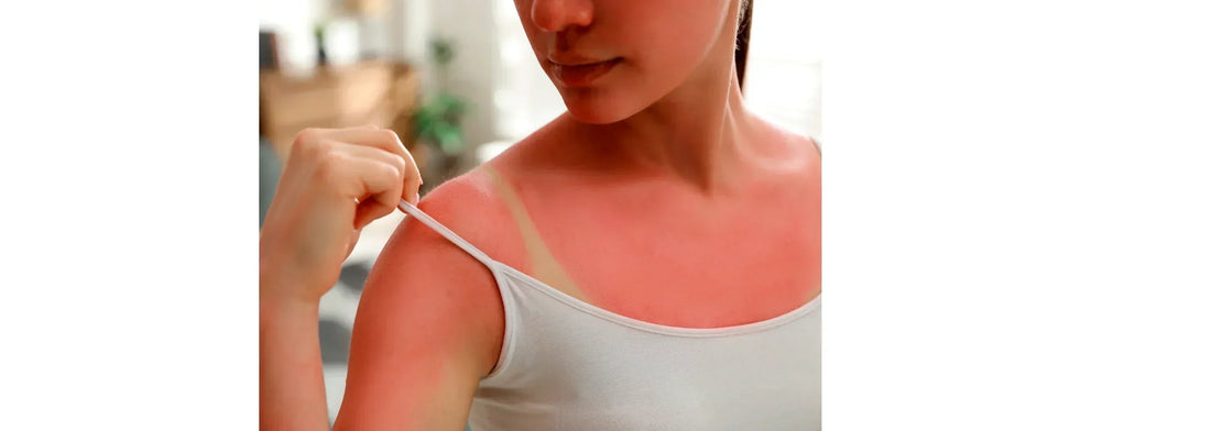 Young woman with a sunburn wearing a tank top. This photo is for YASOU's blog post called "The Impact of Weather On Skin.: