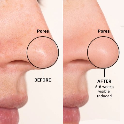 Before and after comparison of pores on a person's nose with text indicating reduced pore size over 5-6 weeks.